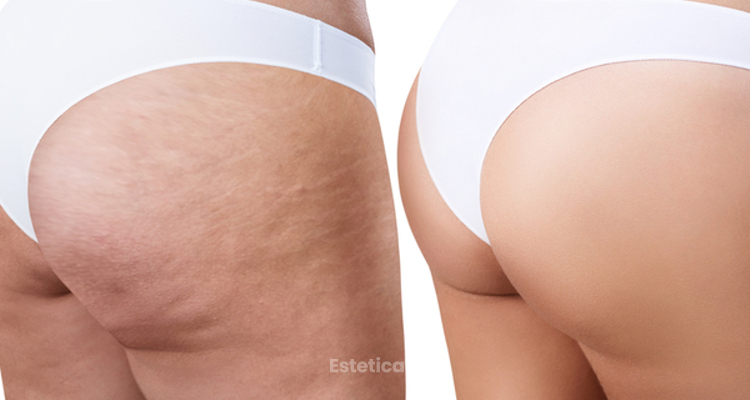 El mejor tratamiento celulitis